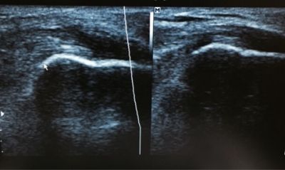 アキレス腱付着部炎最新治療 エコー画像の比較